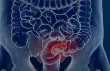 Pacientes com câncer colorretal são diagnosticados em estágio avançado